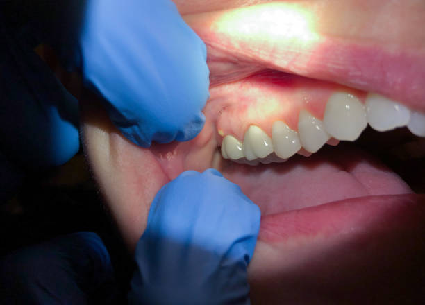 Best Emergency Tooth Extraction in Kana, UT
